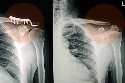 fractured clavicle